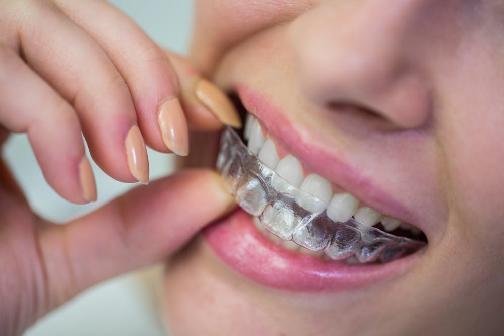 Girl smiling happily with clear aligners image