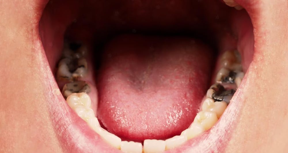 common dental problems