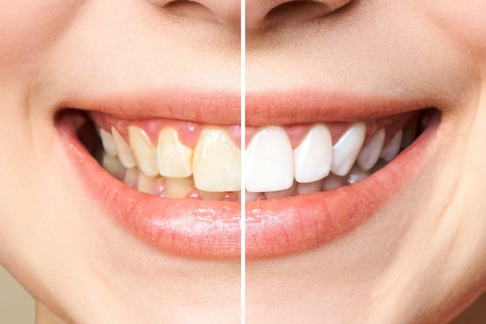 common dental problems