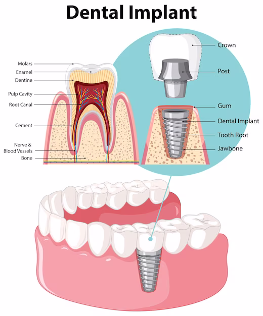 Dental Implants in Dumdum at Smiley Dental Clinic