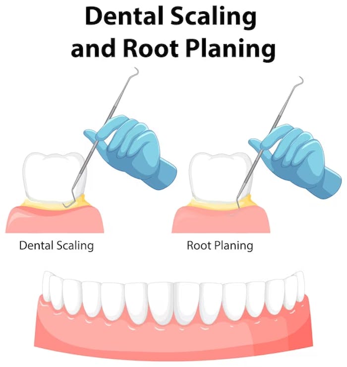 Teeth Scaling in Dumdum