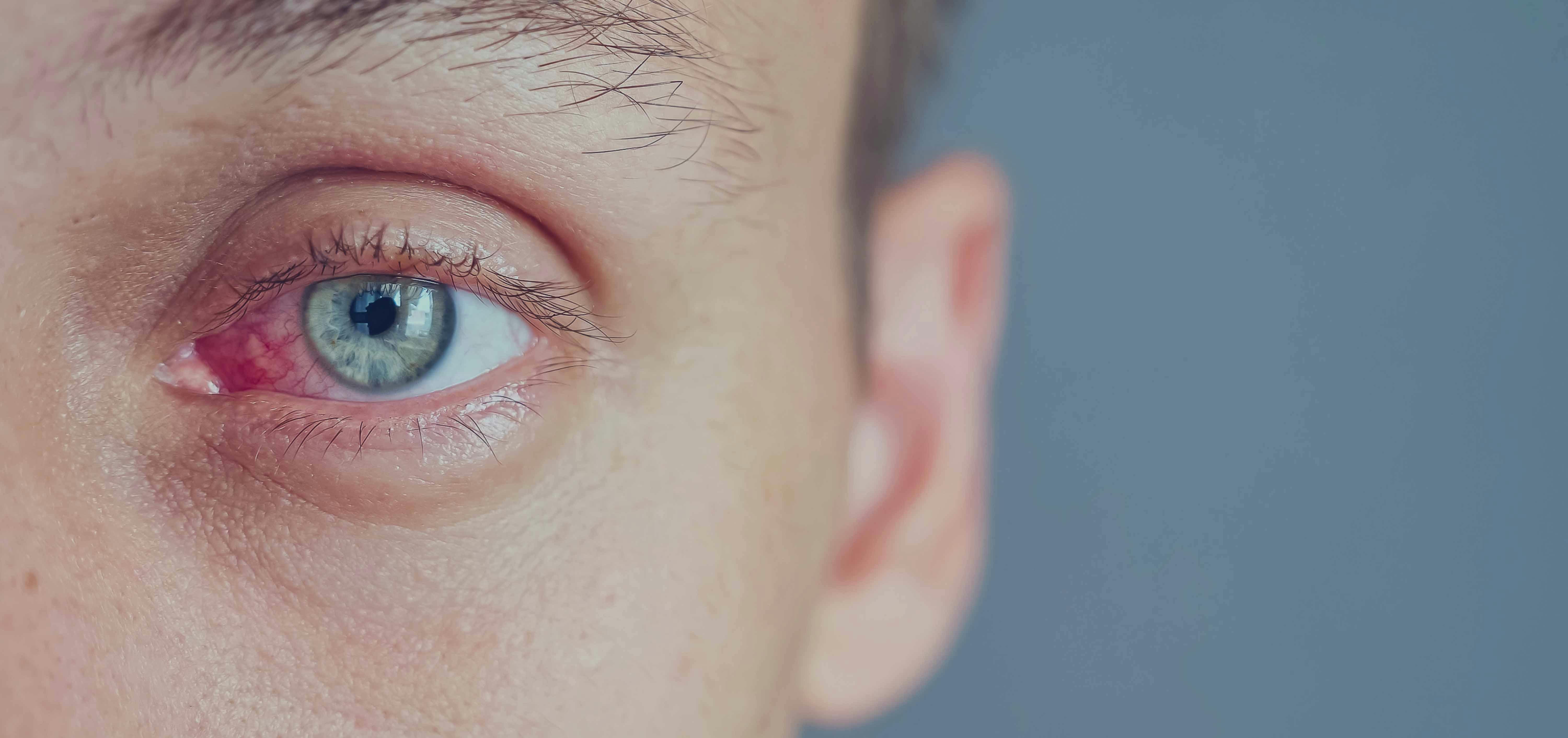 5 raisons qui peuvent expliquer les yeux rouge et quelques solutions
