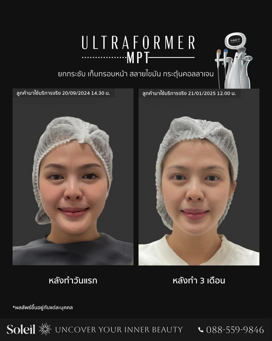 Before, After Ultraformer MPT: เก็บกรอบหน้า