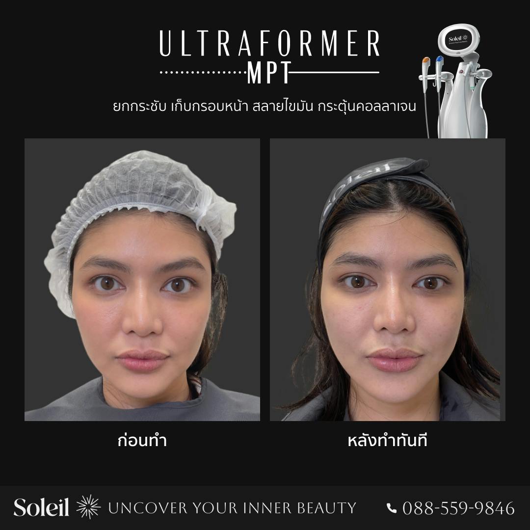 Before, After Ultraformer MPT: เก็บกรอบหน้า