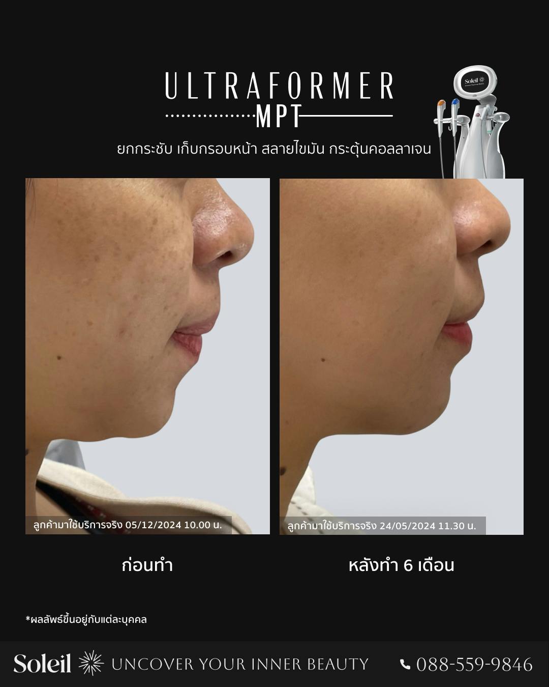 Before, After Ultraformer MPT: ลดเหนียง