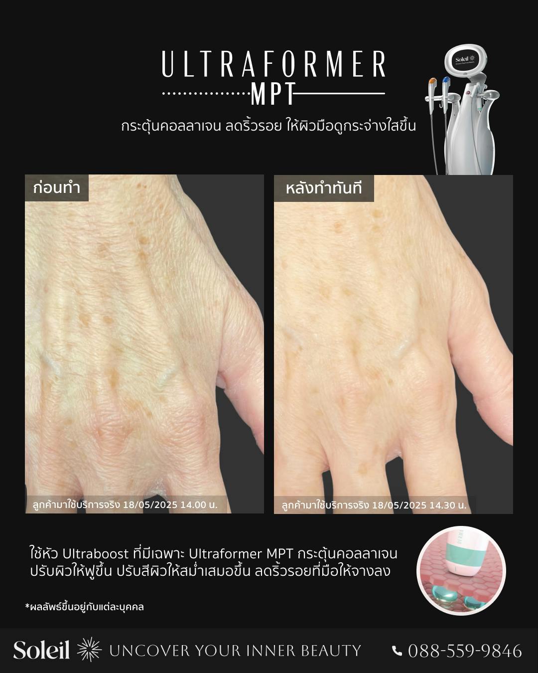 Before, After Ultraformer MPT: เพิ่มคอลลาเจนให้มือ