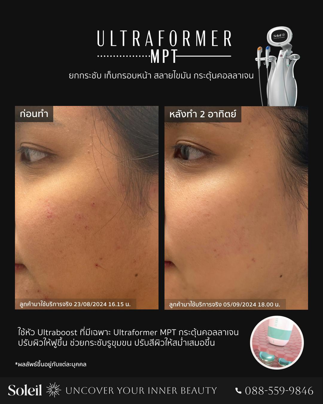 Before, After Ultraformer MPT: ปรับสภาพผิว