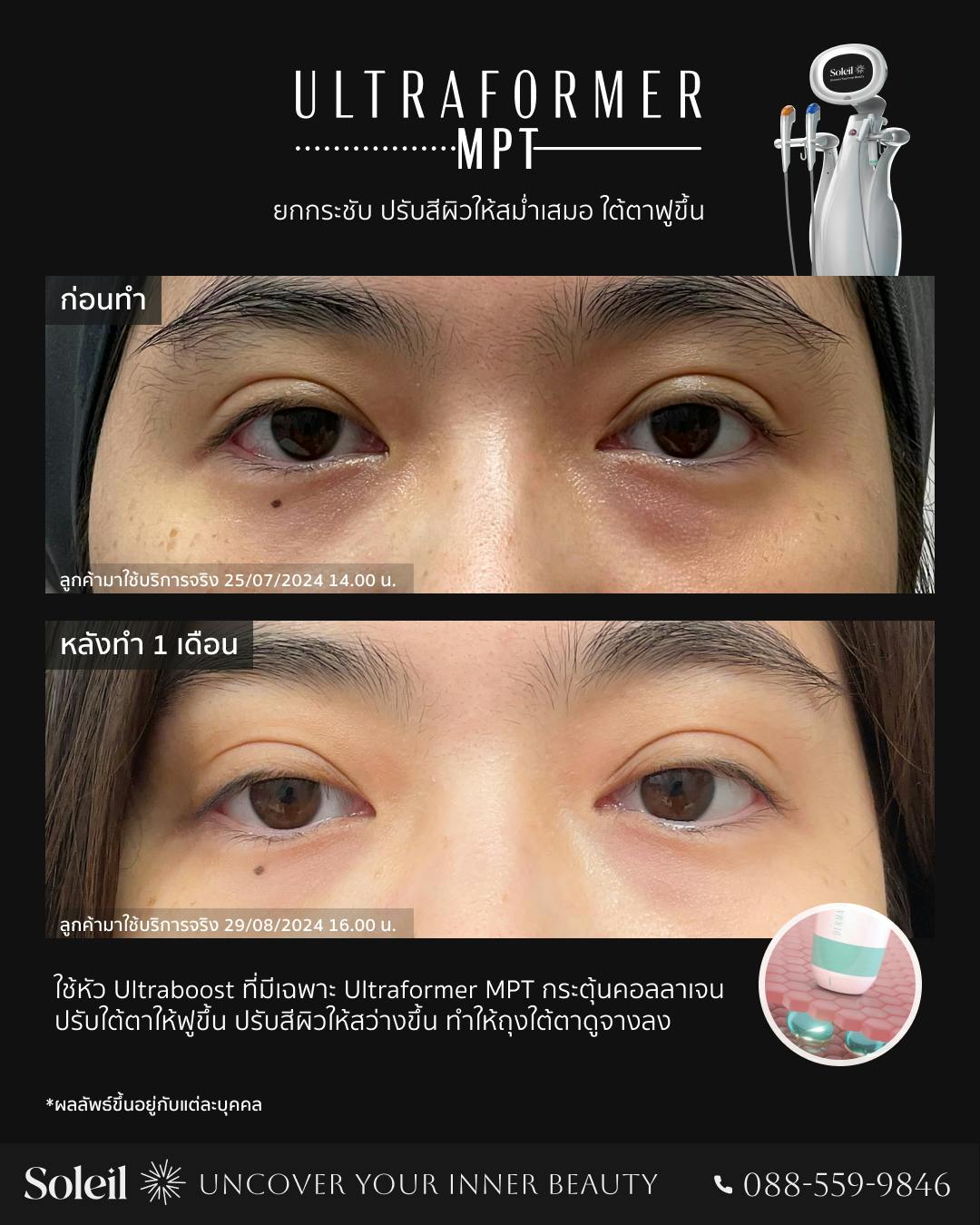 Before, After Ultraformer MPT: ปรับใต้ตาให้ฟูยิ่งขึ้น