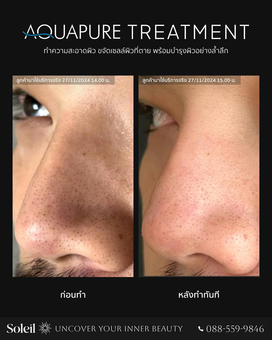 ภาพก่อนและหลังการทำ Aquapure Treatment