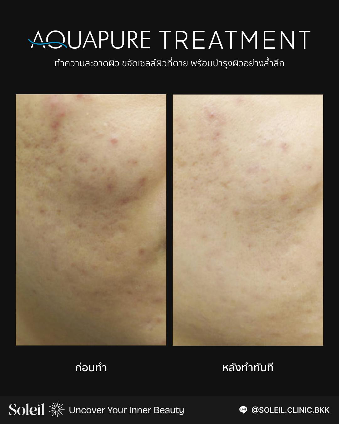 ภาพก่อนและหลังการทำ Aquapure Treatment
