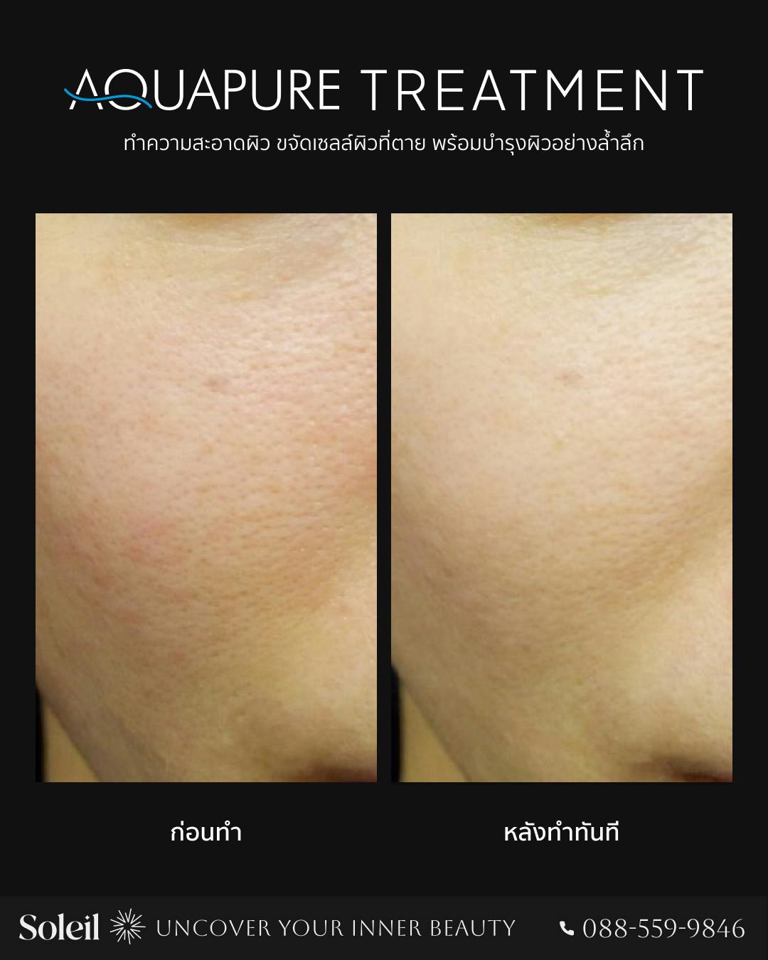 ภาพก่อนและหลังการทำ Aquapure Treatment