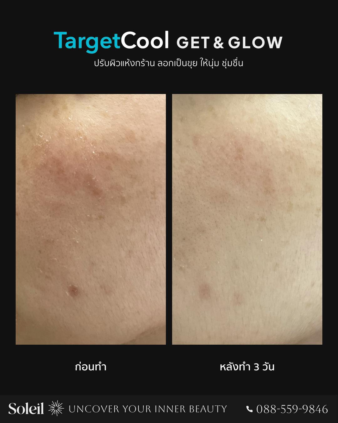 Before-After TargetCool-2