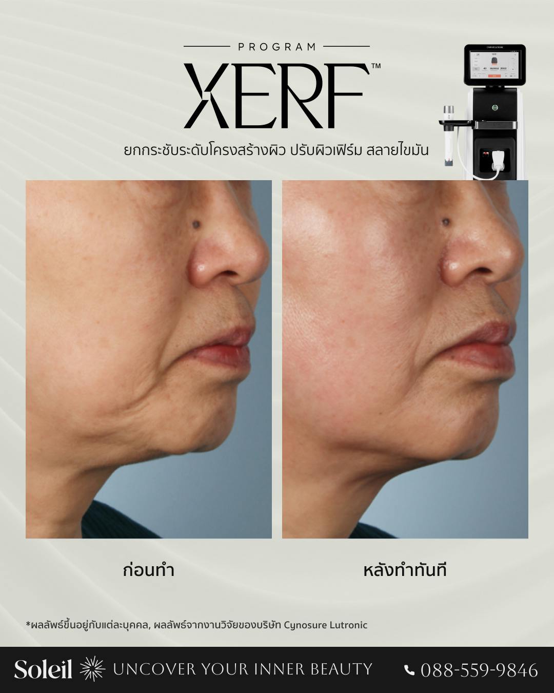 Before-After: XERF ยกกระชับระดับโครงสร้างผิว