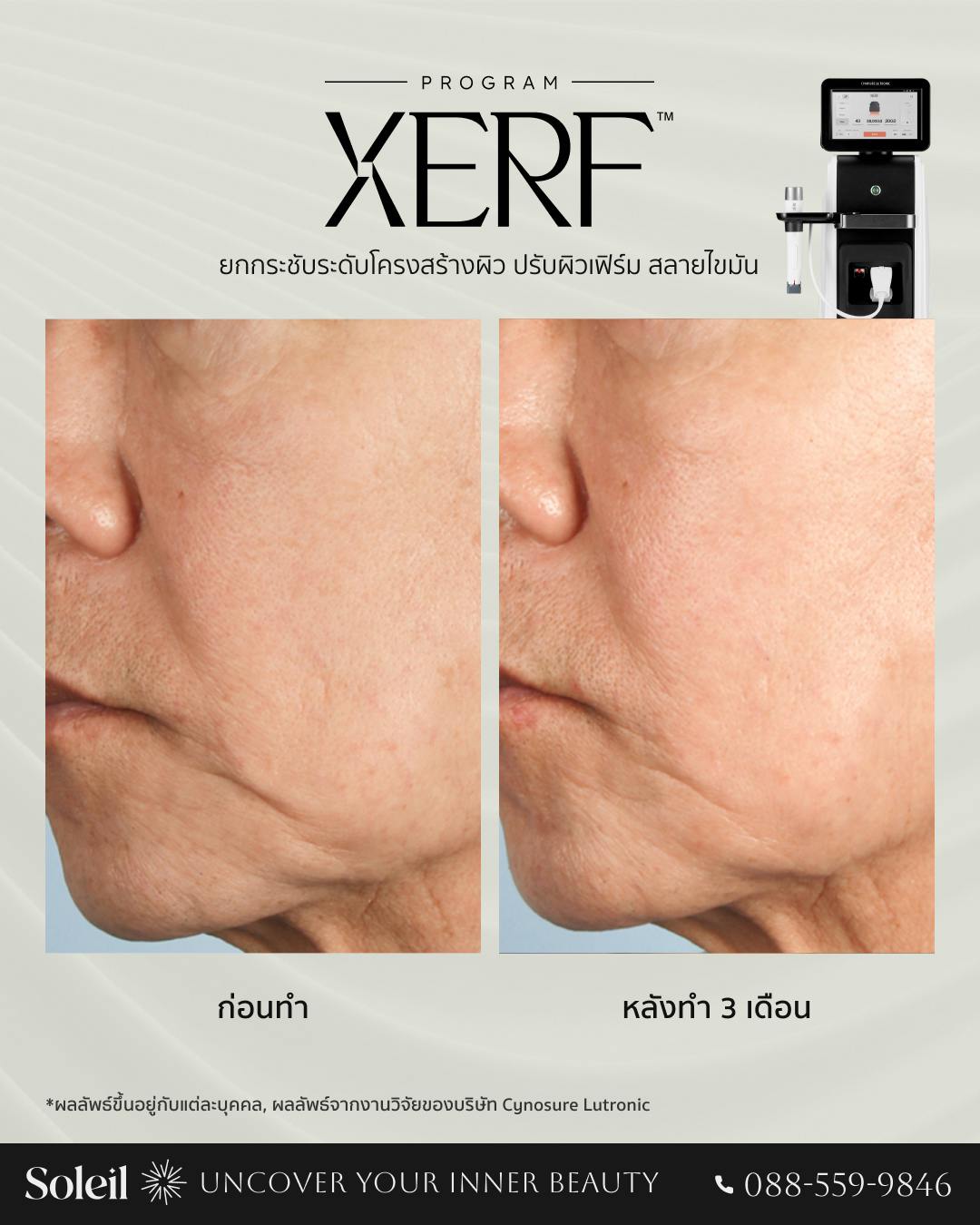 Before-After: XERF ยกกระชับระดับโครงสร้างผิว