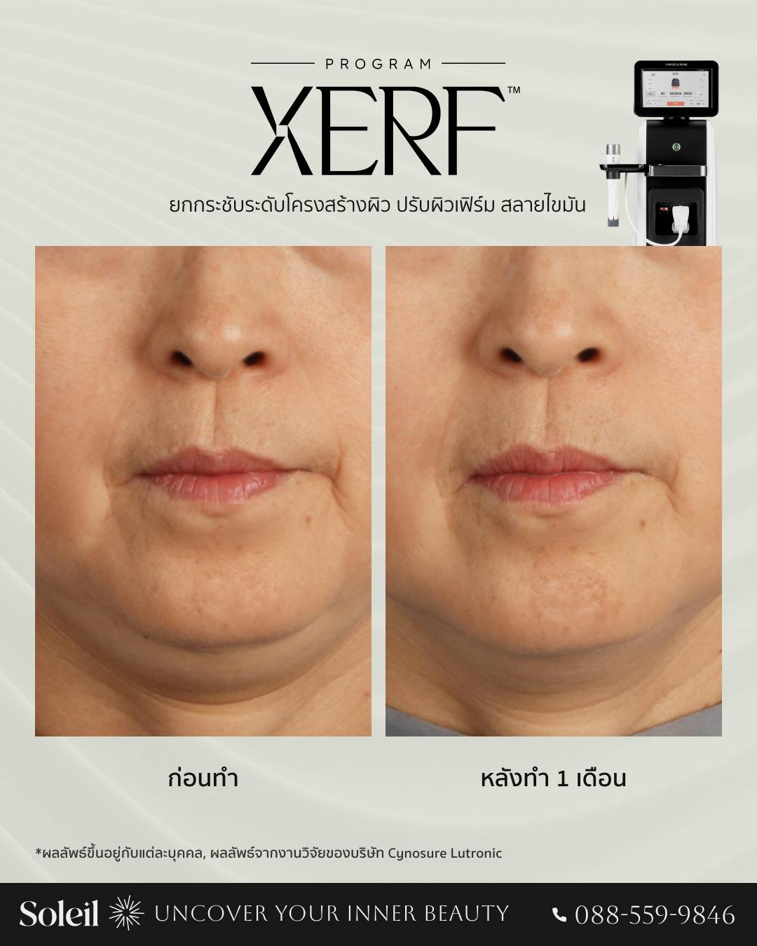 Before-After: XERF ยกกระชับระดับโครงสร้างผิว