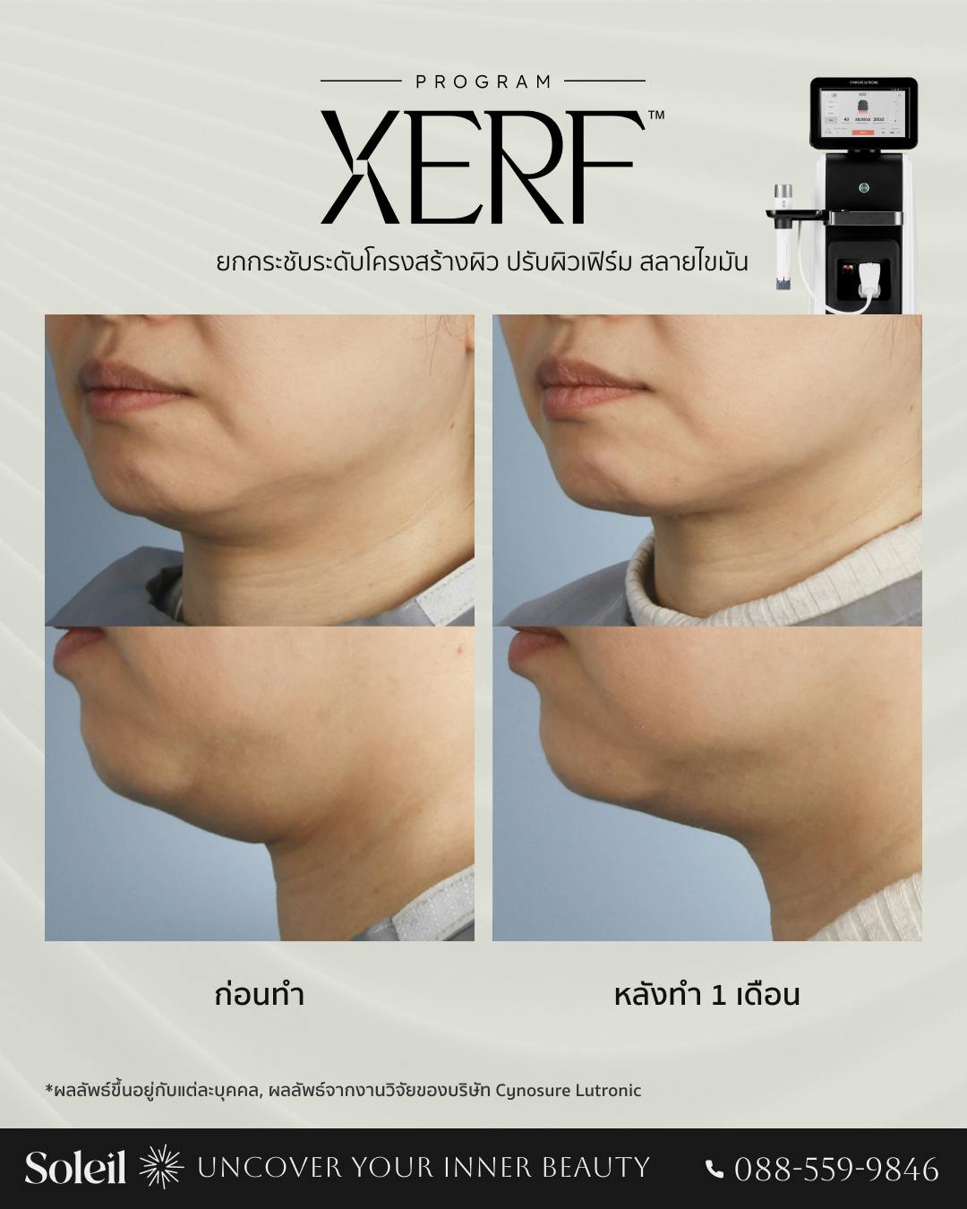 Before-After: XERF ยกกระชับระดับโครงสร้างผิว