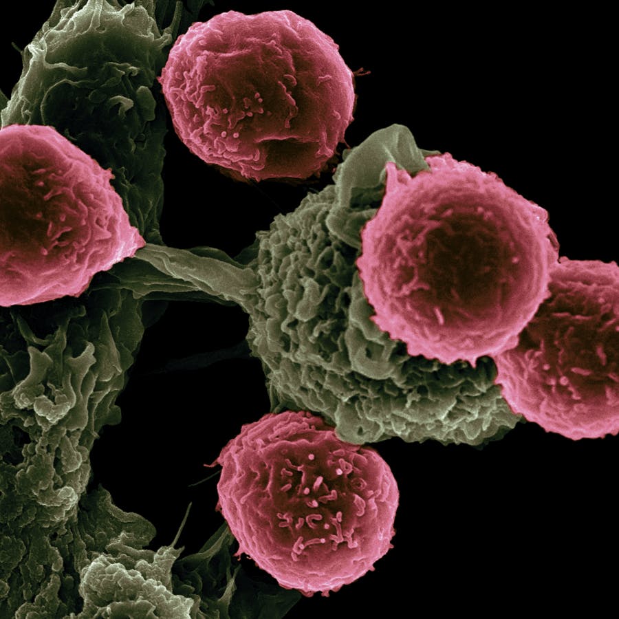 Celulas cancerígenas no microscópio
