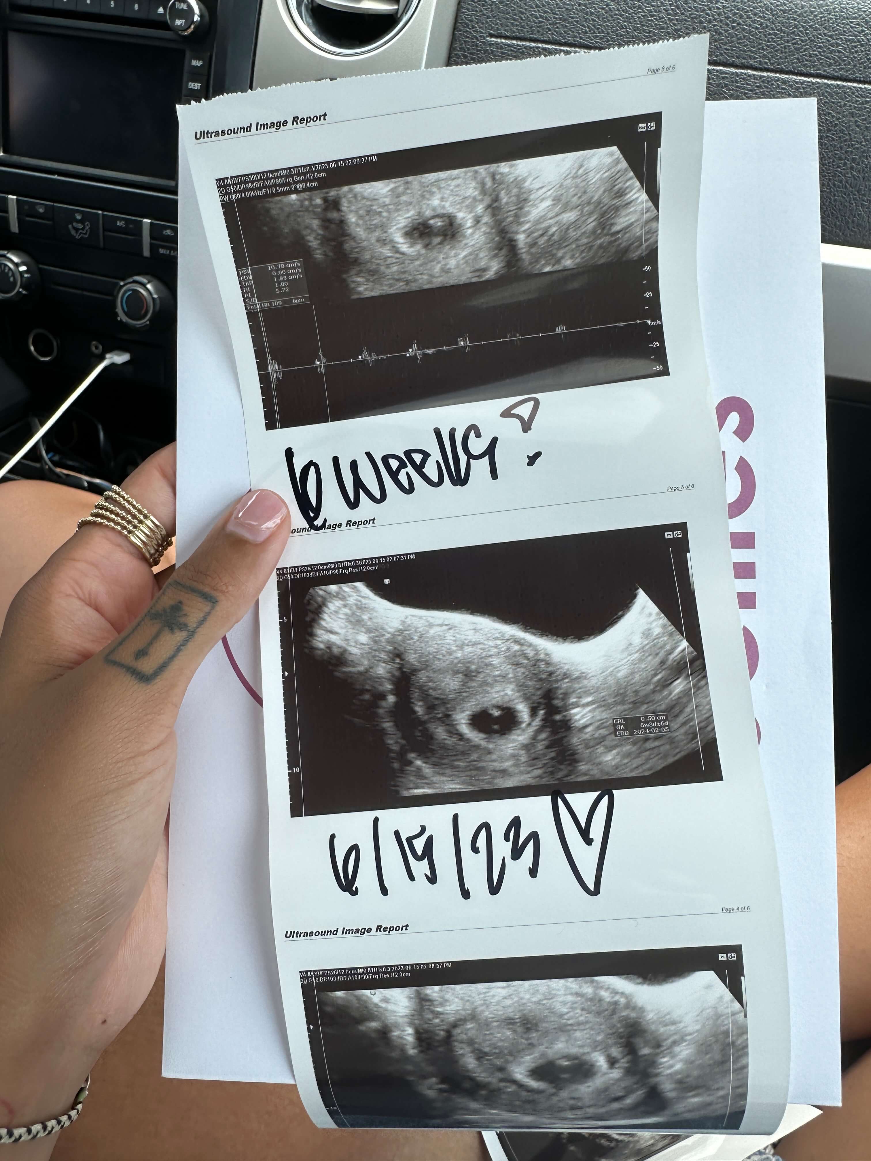 sonogram photos of a baby