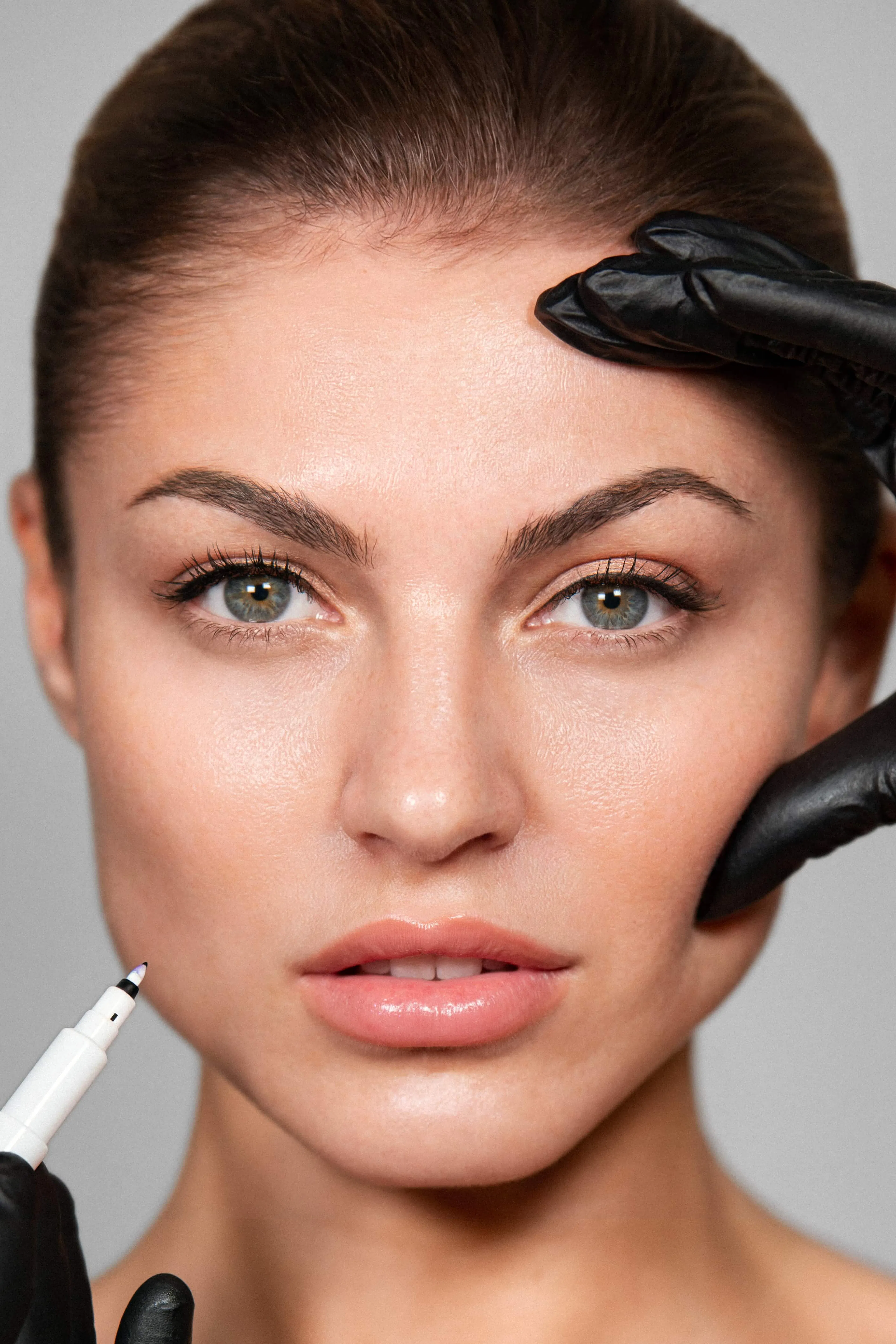 Marionettenfalte Behandlung mit Hyaluron bei SA Aesthetics Berlin