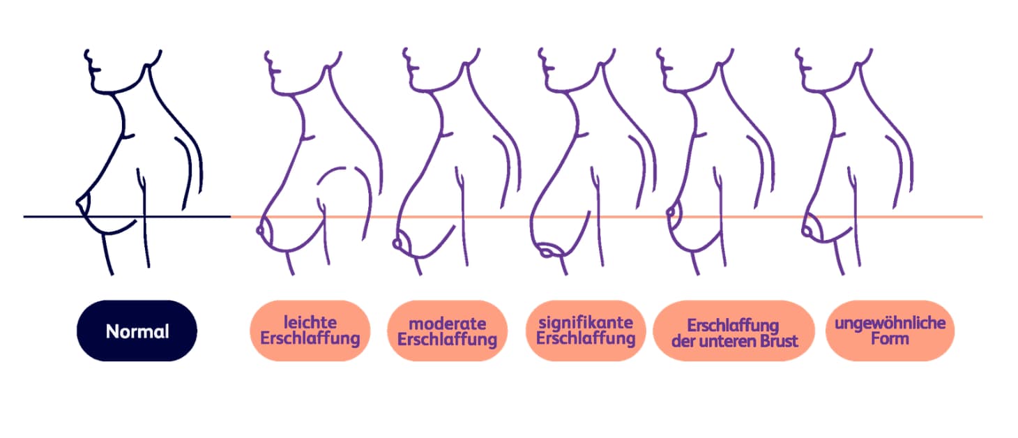 Warum erschlafft die Brust?