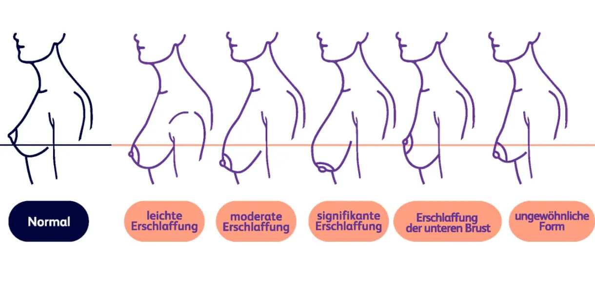 Warum erschlafft die Brust?