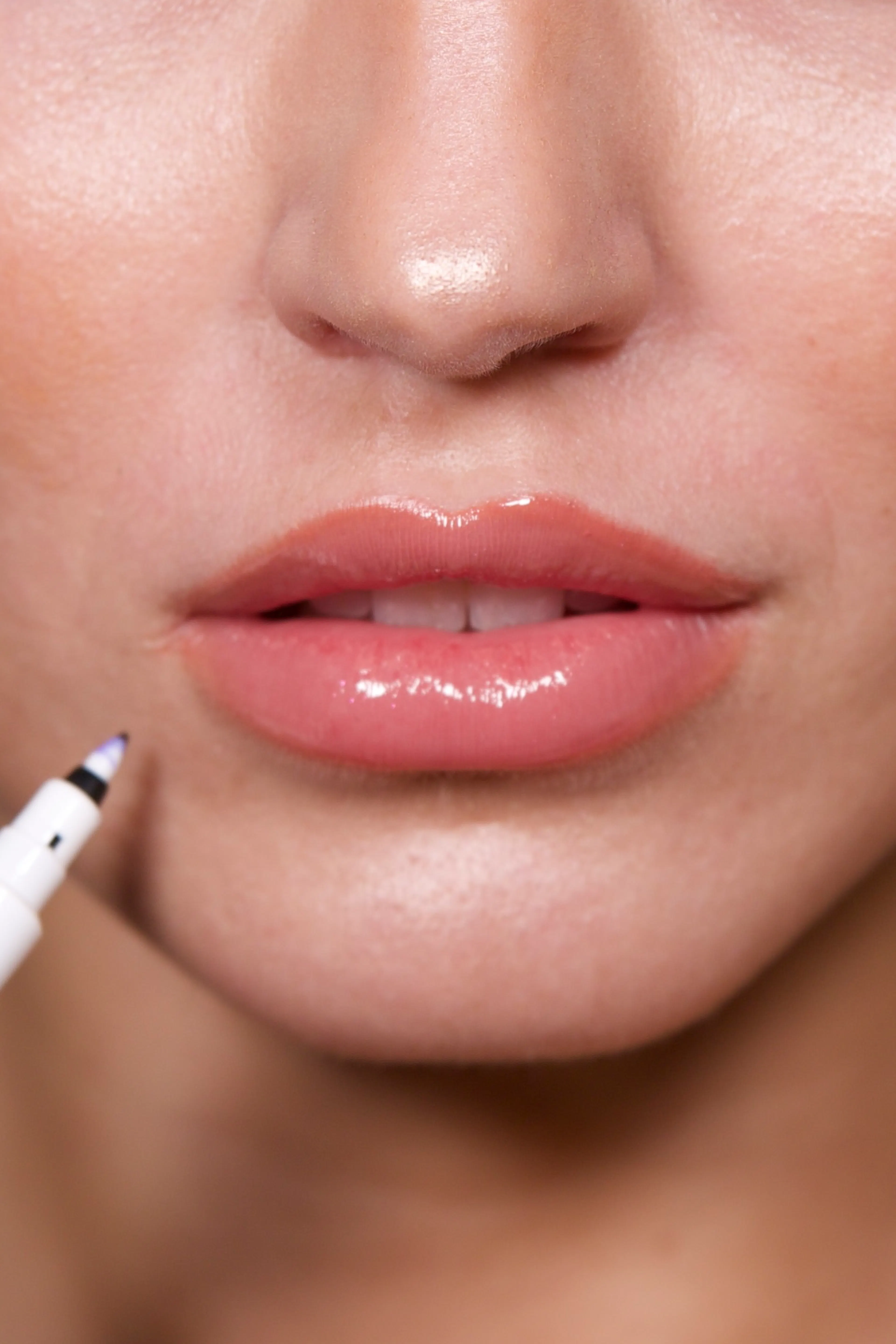Patientin Lippen Stavrakis Aesthetics