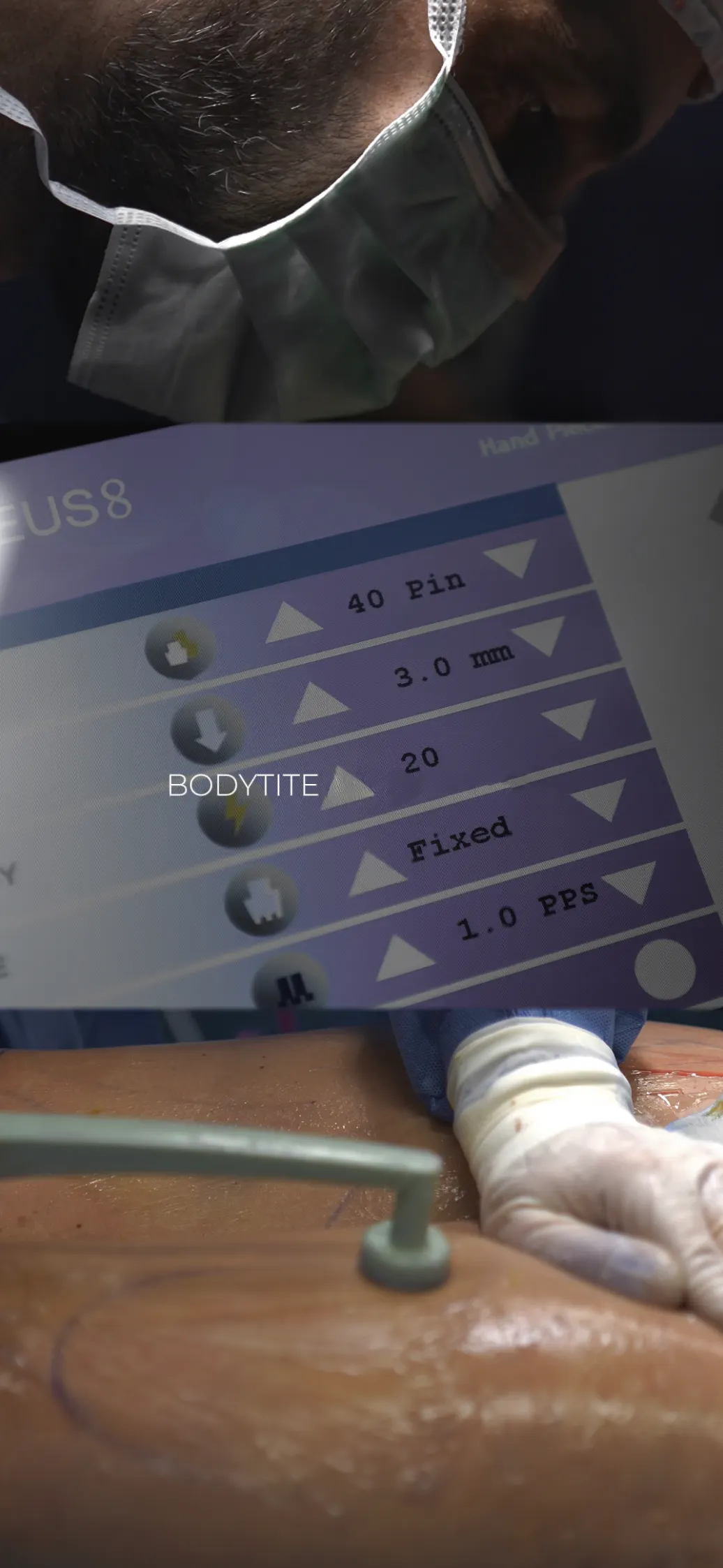 bodytite
