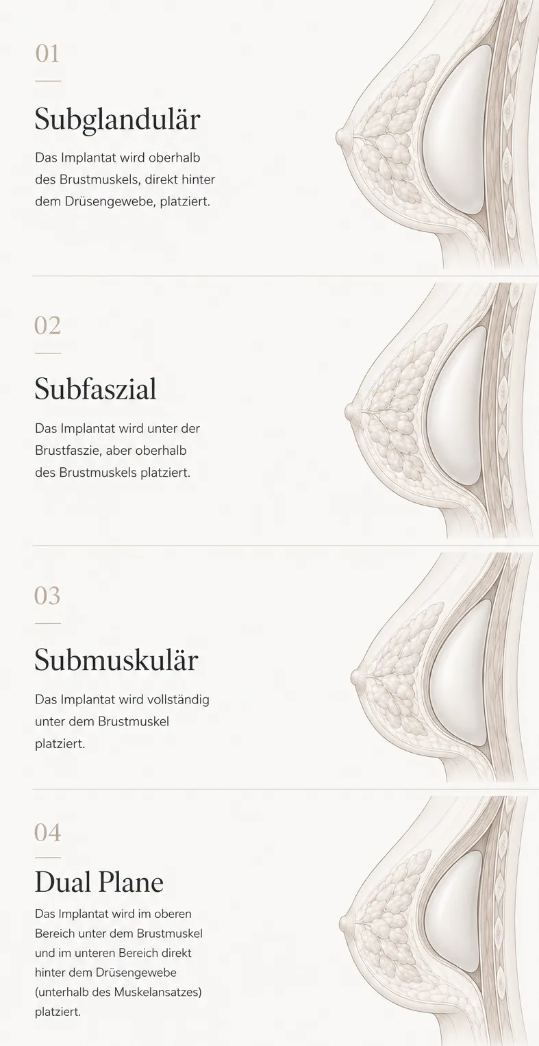Schematische Darstellung Implantatposition