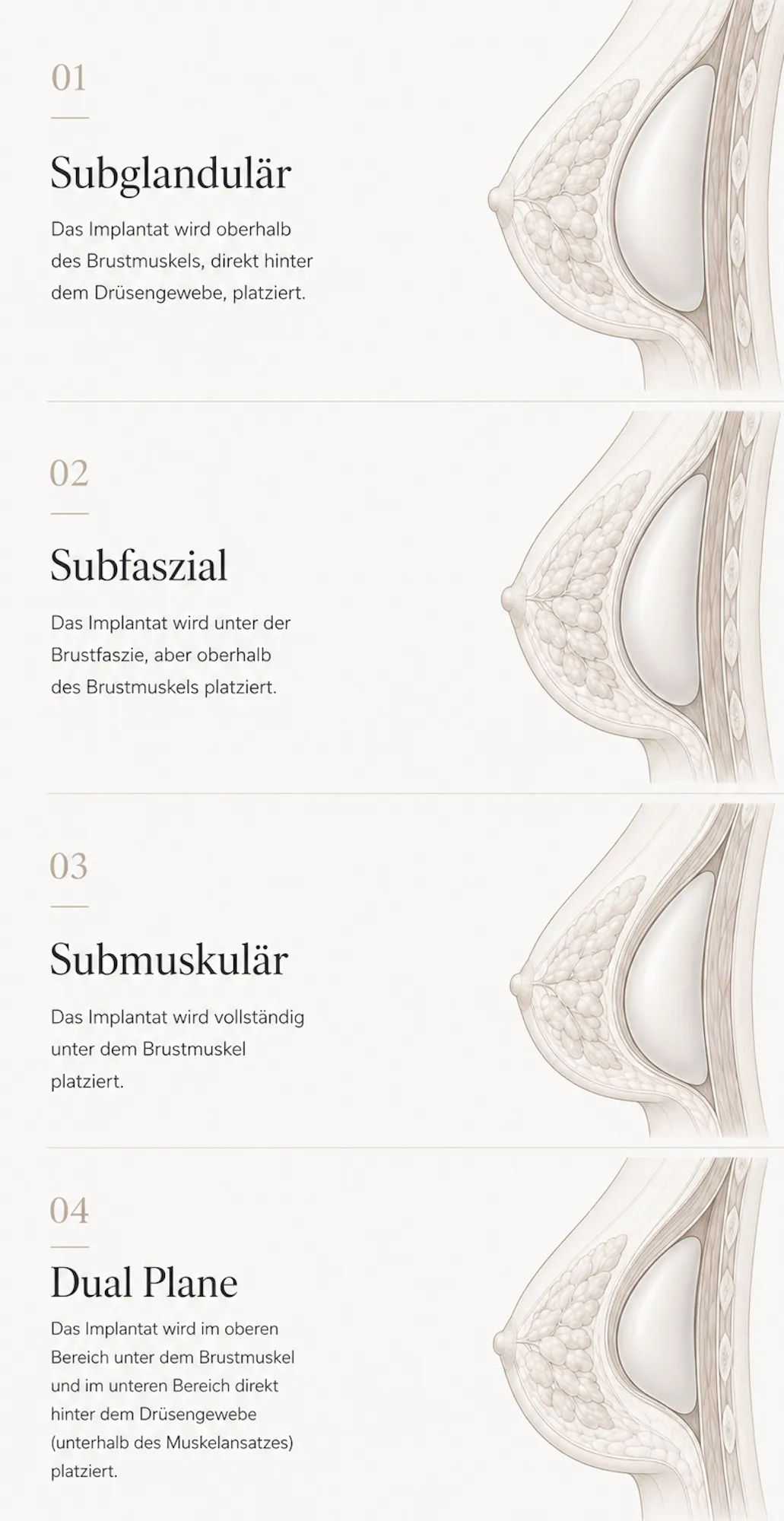 Schematische Darstellung Implantatposition