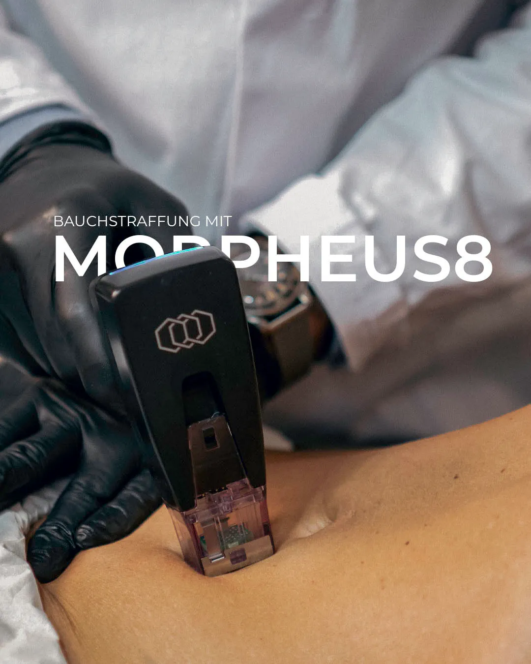 Bild von Morpheus8 Gerät bei einer Behandlung