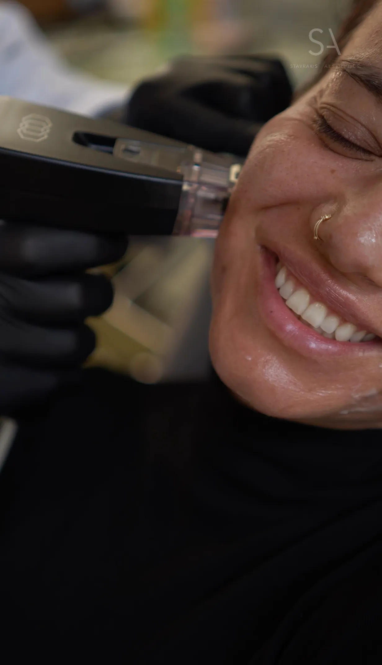 Morpheus8® Behandlung bei SA Aesthetics Berlin
