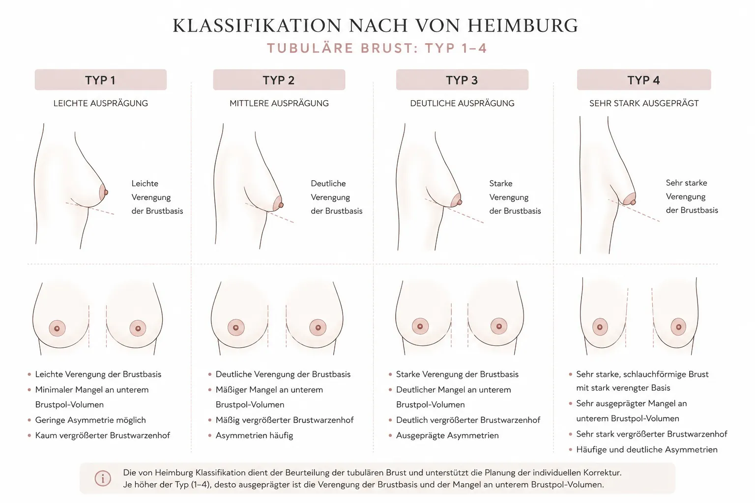 Grafische Darstellung der verschiedenen Formen und Ausprägungen einer tubulären Brust