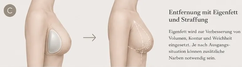 Grafische KI-Illustration zu Implantatentfernung und Bruststraffung mit Eigenfett