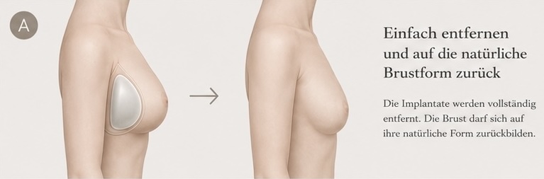 Grafische KI-Illustration zu Implantatentfernung