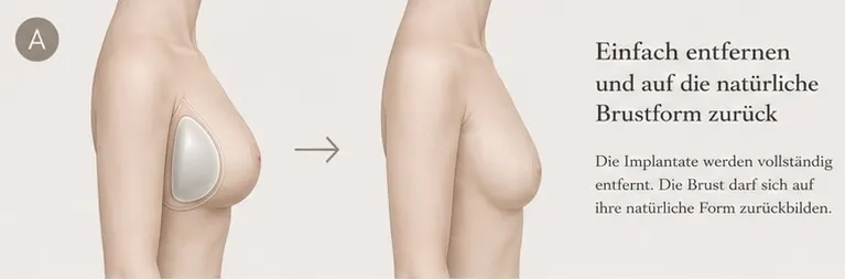 Grafische KI-Illustration zu Implantatentfernung