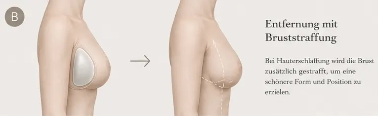 Grafische KI-Illustration zu Implantatentfernung mit Bruststraffung