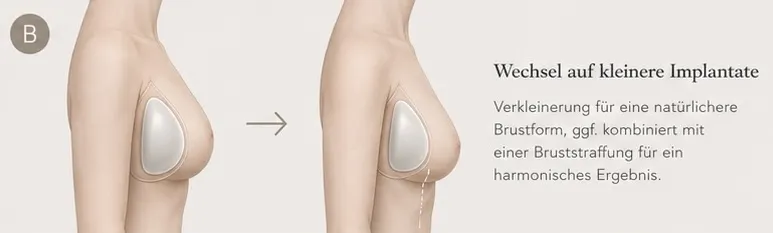 Grafische KI-Illustration zu Implantatwechsel auf kleinere Implantate