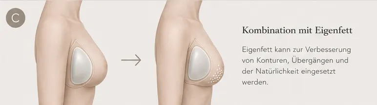 Grafische KI-Illustration zu Implantatwechsel und Kombination mit Eigenfett