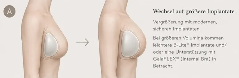 Grafische KI-Illustration zu Implantatwechsel auf größere Implantate