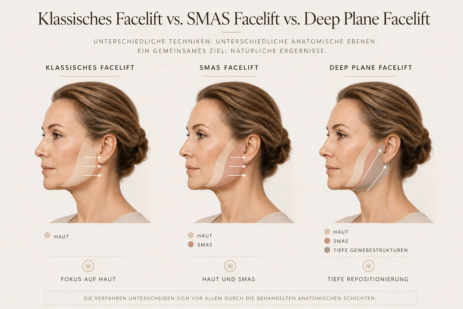 Schematische Darstellung Vergleich Facelift Methoden
