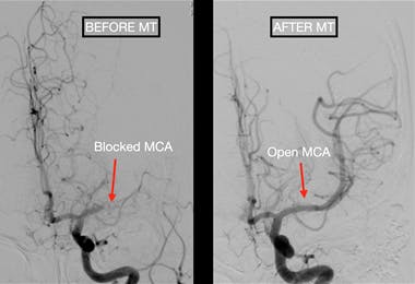 Road to Recovery in Stroke: Mechanical Thrombectomy