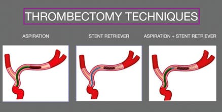 Road to Recovery in Stroke: Mechanical Thrombectomy