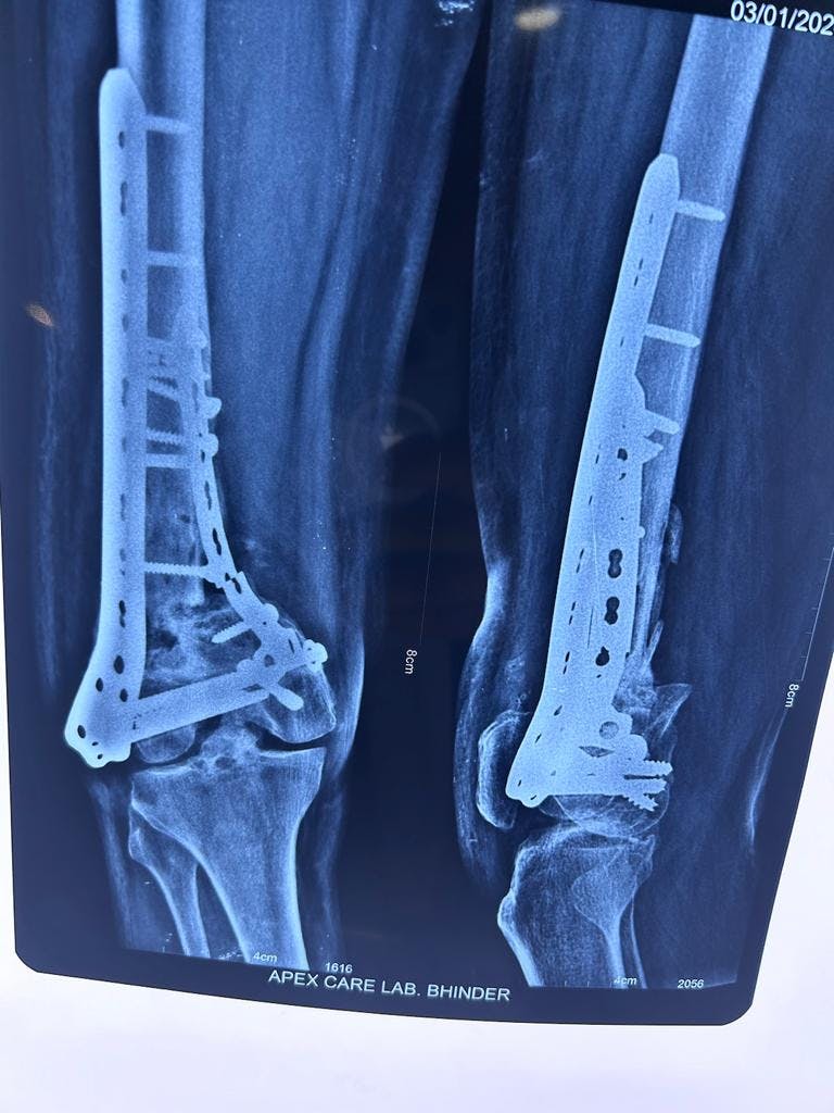 Precision in Practice: A Complex Case Successfully Handled by the Sterling Arthroplasty Team