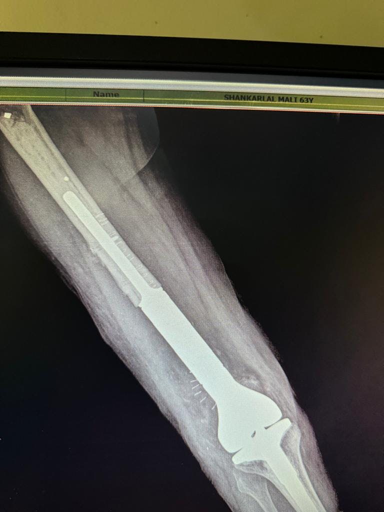 Precision in Practice: A Complex Case Successfully Handled by the Sterling Arthroplasty Team