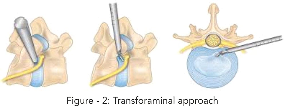 Welcome to the “Endoscopic Spine Surgery” Era