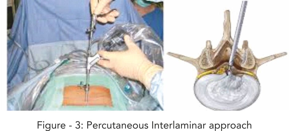 Welcome to the “Endoscopic Spine Surgery” Era