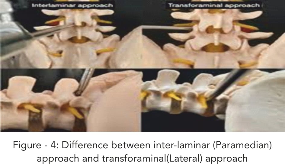 Welcome to the “Endoscopic Spine Surgery” Era