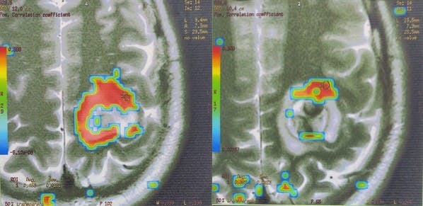 Cavernous Malformation