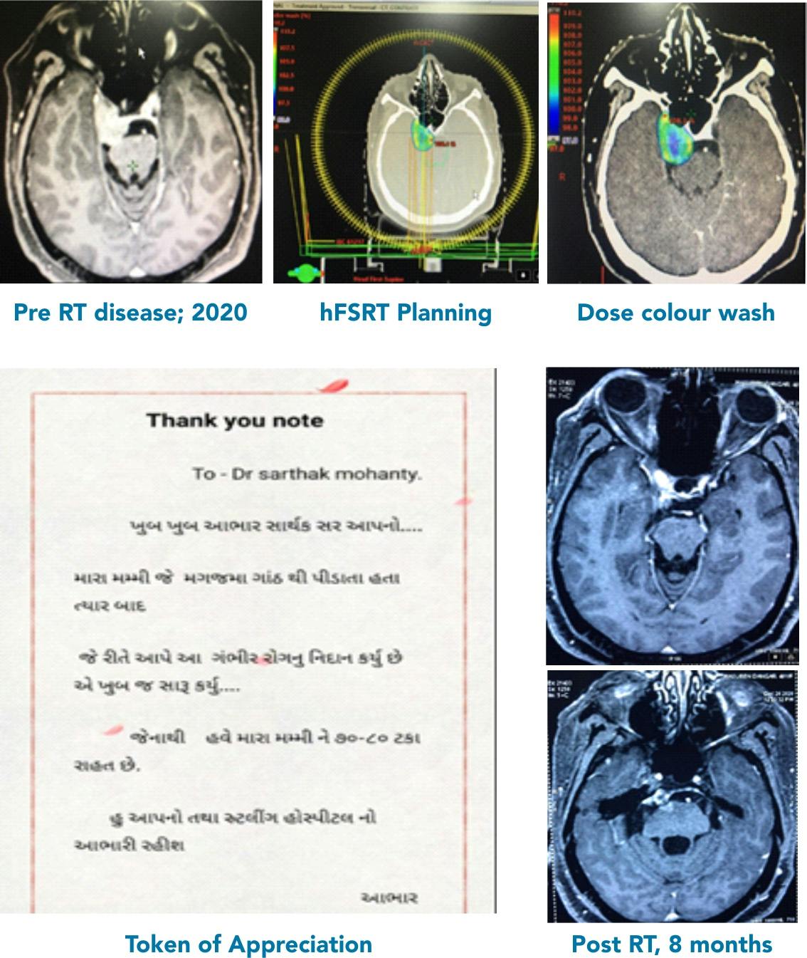 Hypofractionated Stereotactic Radiotherapy (hFSRT) by Halcyon in a case of Pre-Pontine Meningioma - A Case Report