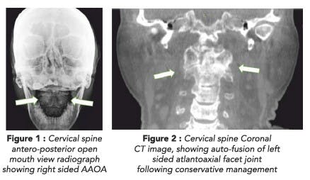 Spinal Health: Focusing on the Head and Tail Ends